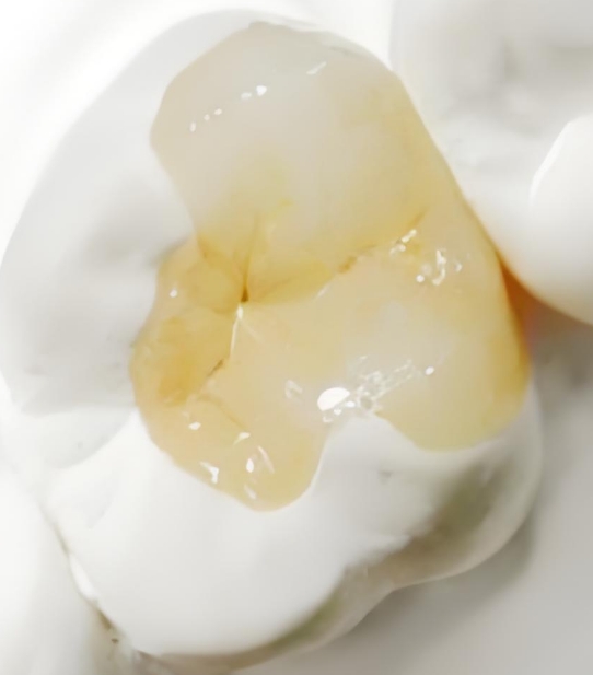 牙科树脂是什么东西